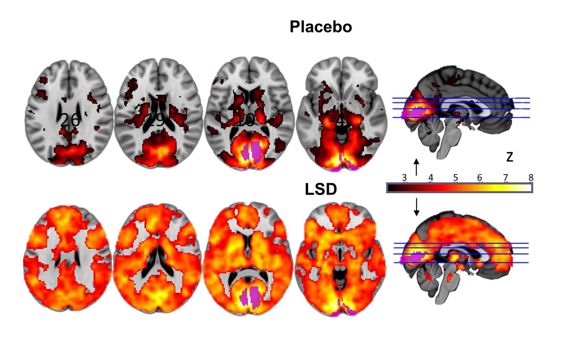 brain scan LSD creative problem solving