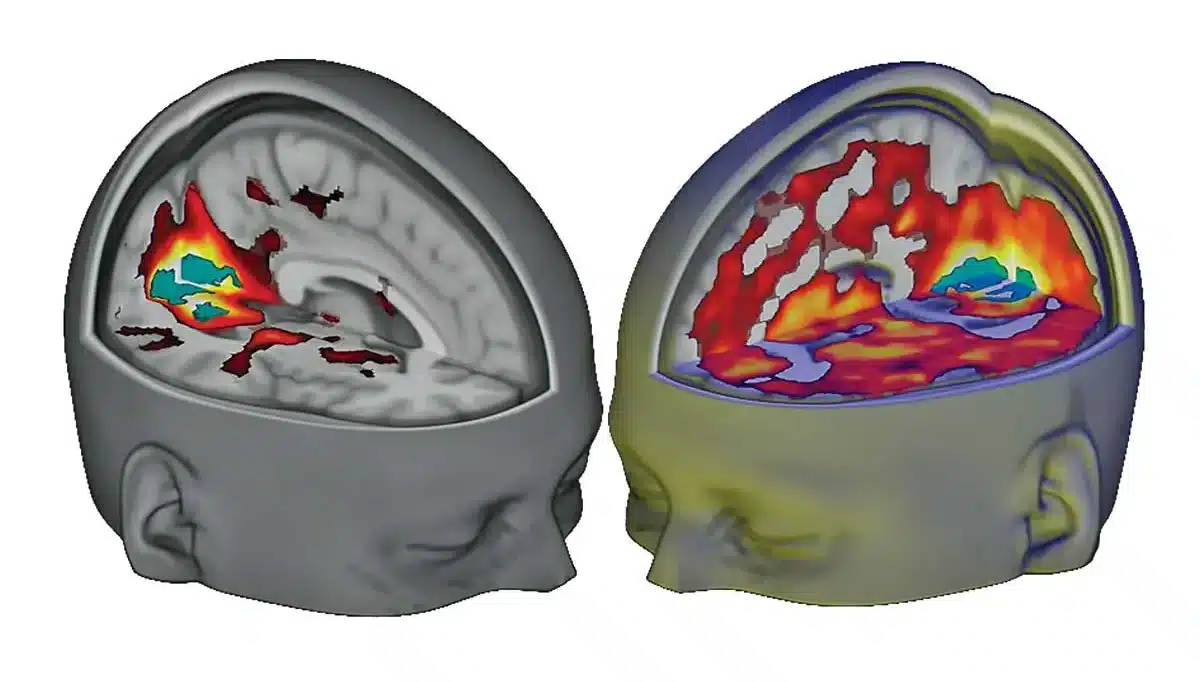 lsd brain image shows how the entire brain activates on LSD, supportive for treating psychological wounds